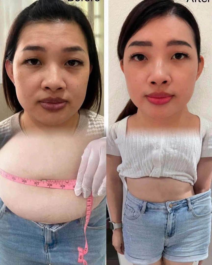 TangMei body contouring transformation, before on the left and after on the right