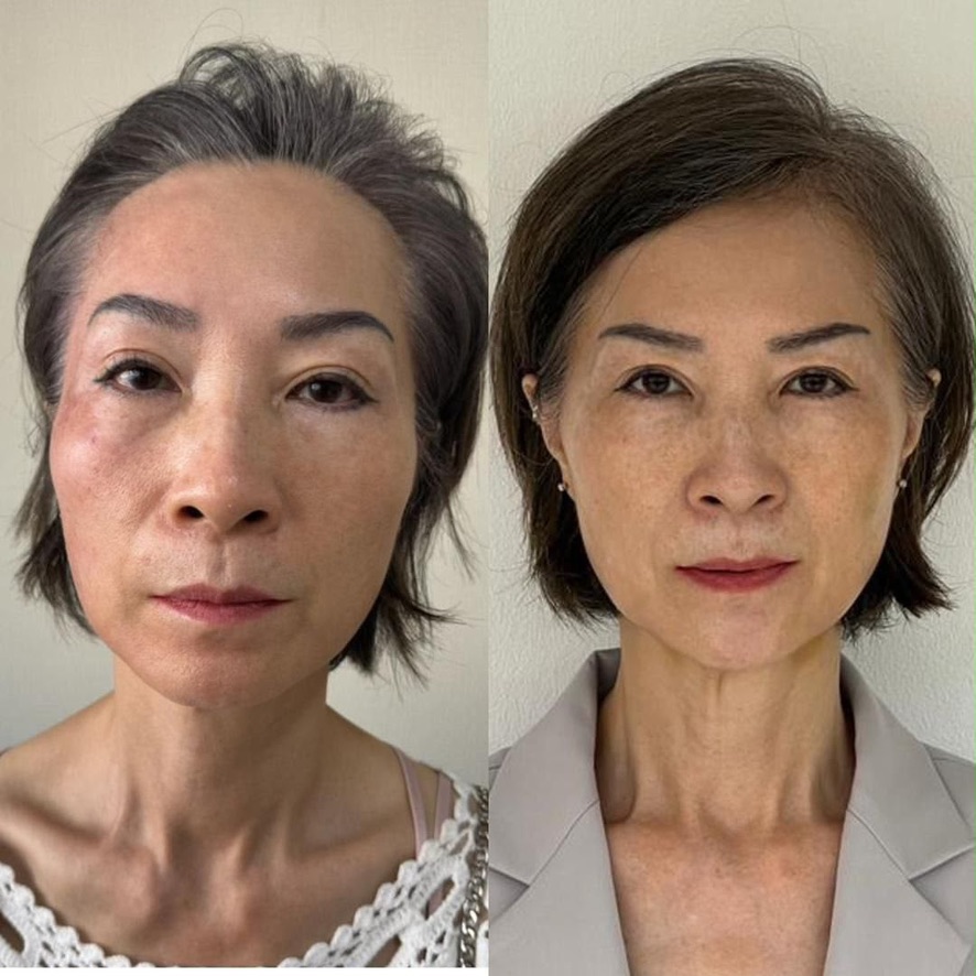 Female TM facial contour transformation, before on the left and after on the right