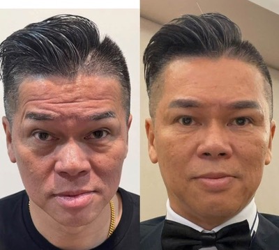 Male TM facial transformation, before on the left and after on the right
