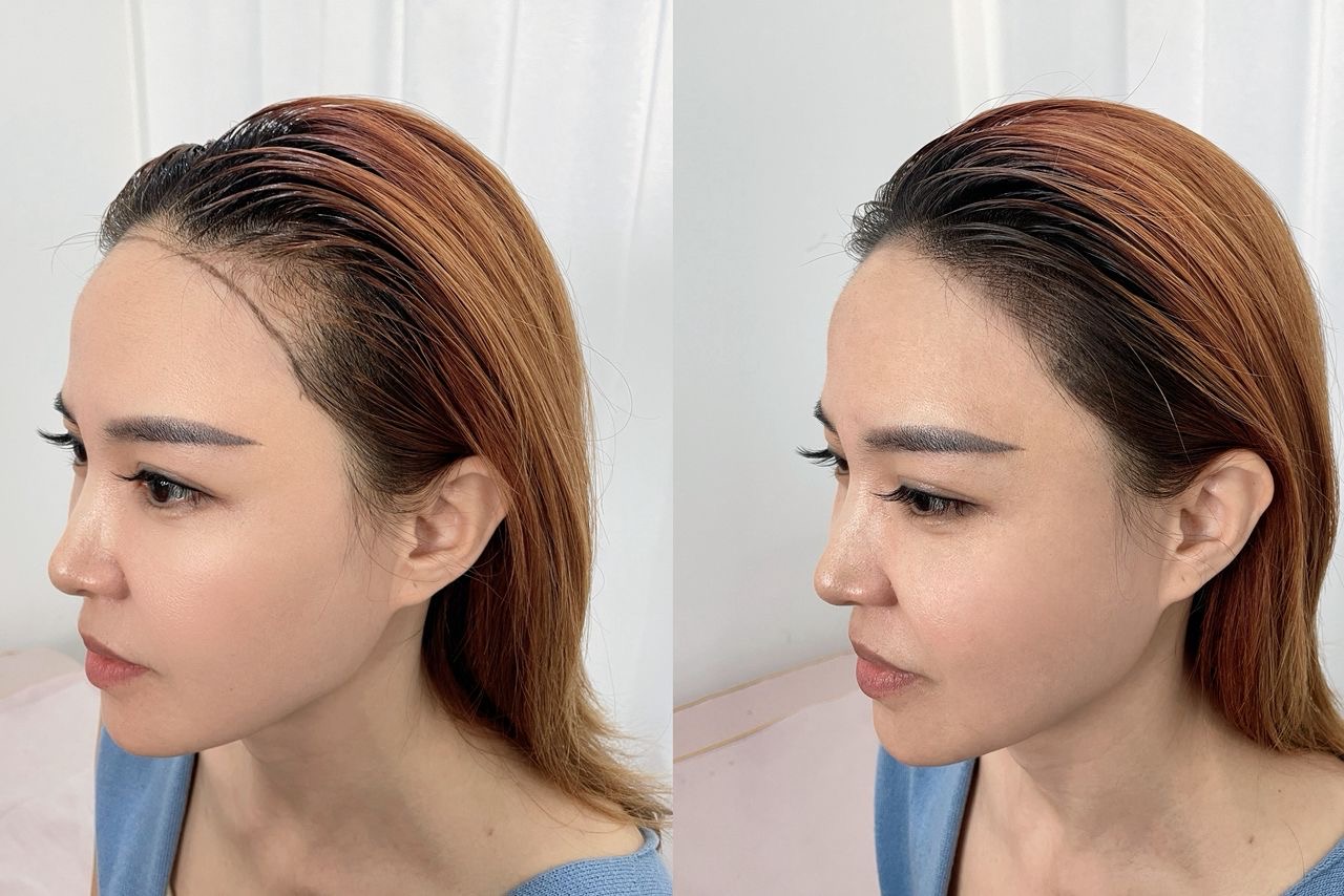 TM hair growth treatment transformation, before on the left and after on the right