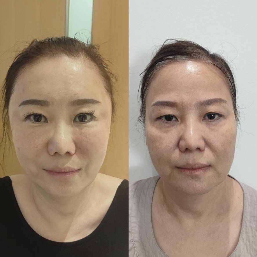 Yvonne's personal facial transformation, after on the left and before on the right